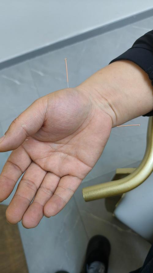 温州哪个医院针灸好