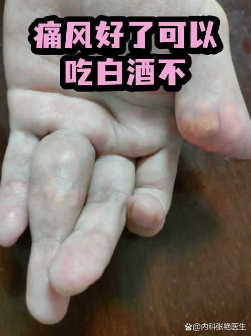 痛风期间能喝白酒吗