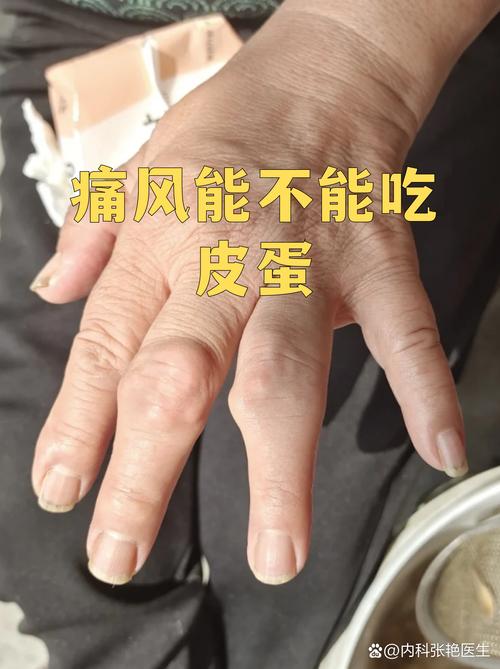 痛风病人能吃猪皮吗