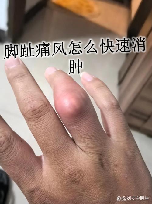 大脚趾痛风如何治疗