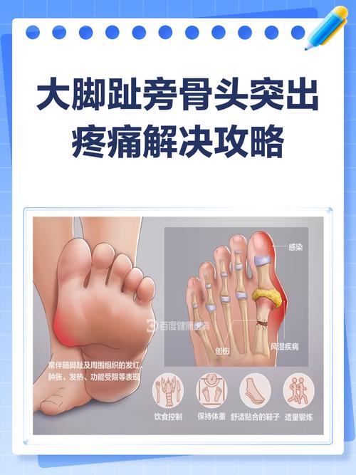 大脚趾痛风如何治疗