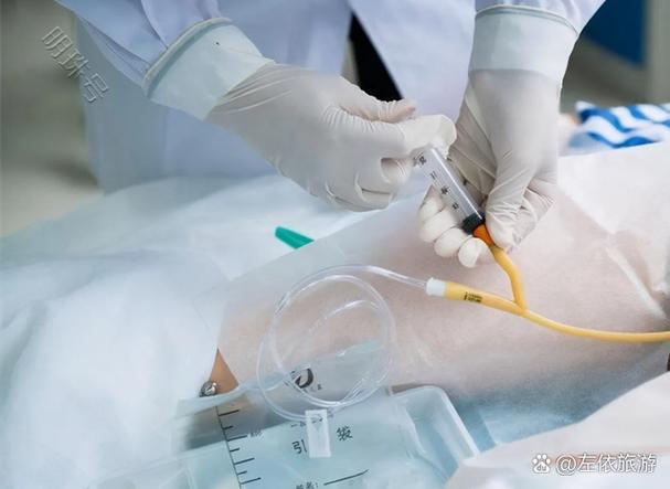 针灸治疗术后尿潴留