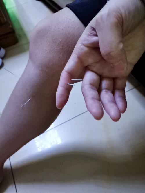 针灸治疗术后尿潴留