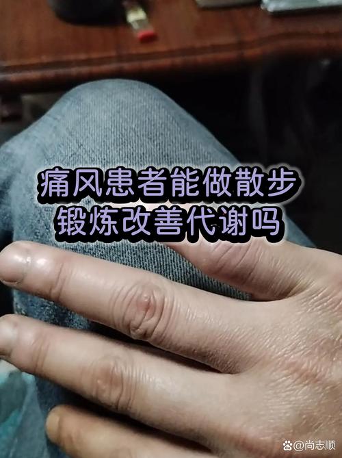 痛风多锻炼有效果吗