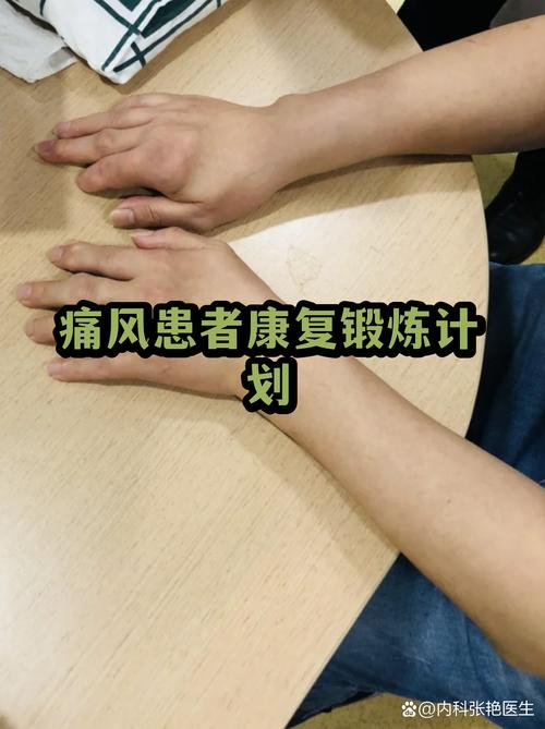 痛风多锻炼有效果吗