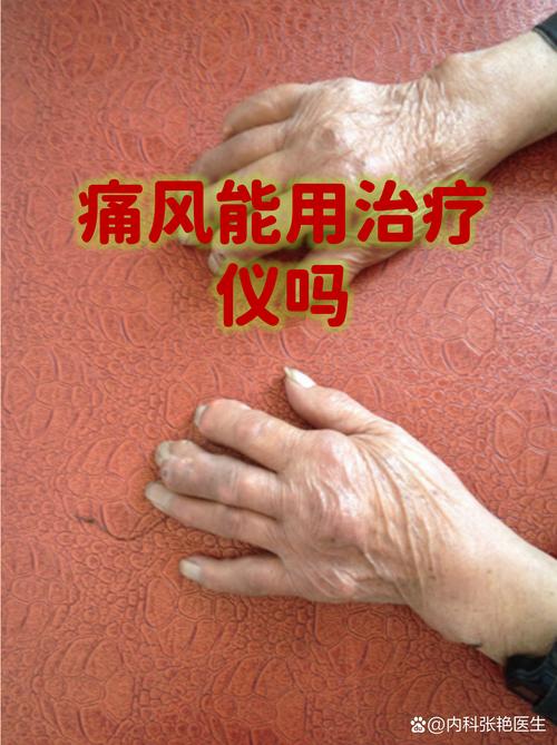 痛风发作可以吹风吗