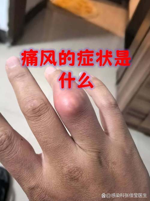 痛风发作可以吹风吗