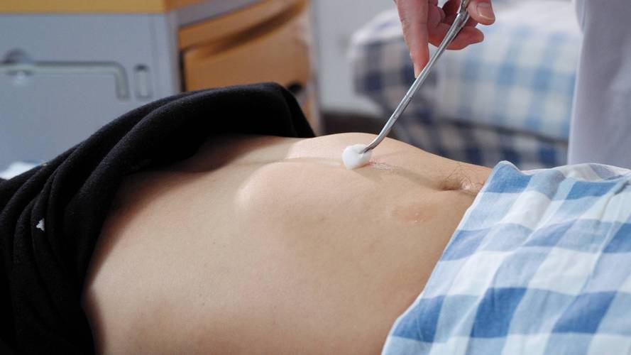 针灸能治疗子宫下垂