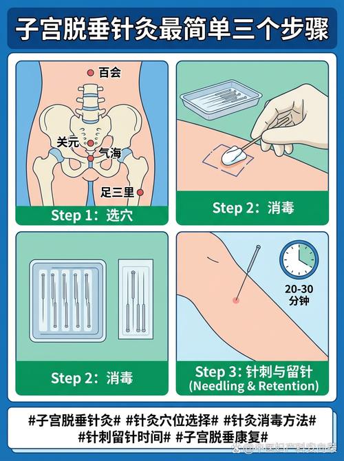针灸能治疗子宫下垂