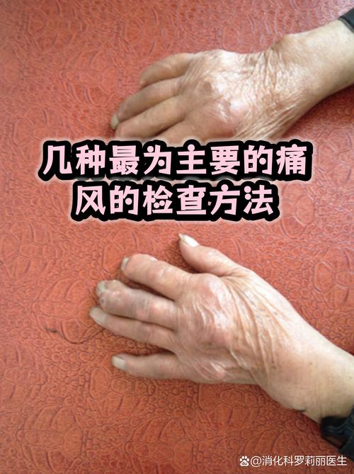 痛风病人跑多少公里