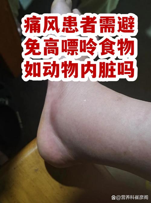 痛风病人跑多少公里