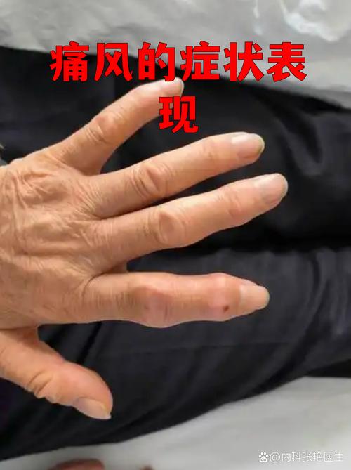 男性痛风能要小孩吗