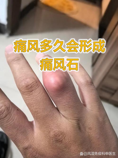 痛风结节的临床表现