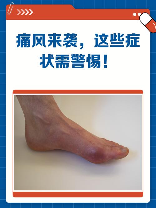 痛风结节的临床表现