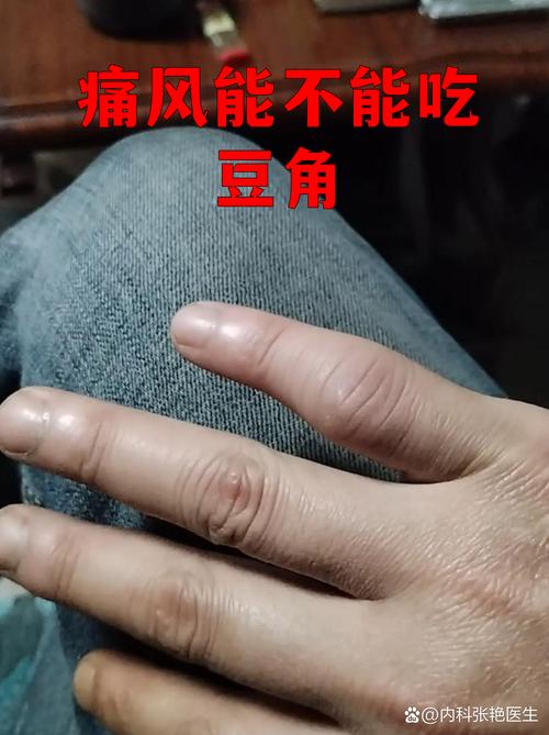 痛风病人能吃啥豆角
