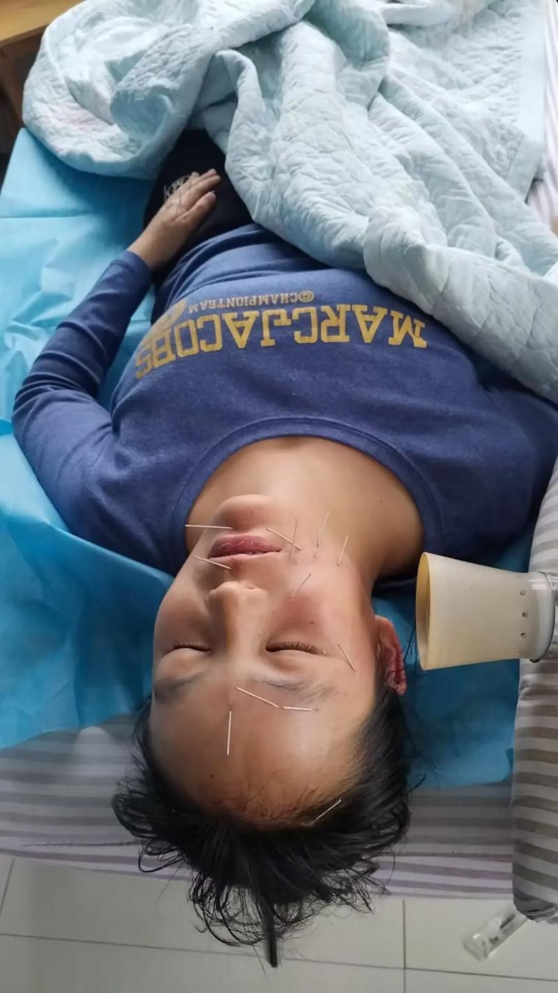 儿童面瘫可以针灸吗