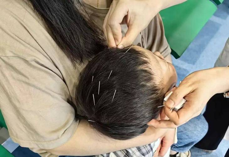 儿童面瘫可以针灸吗