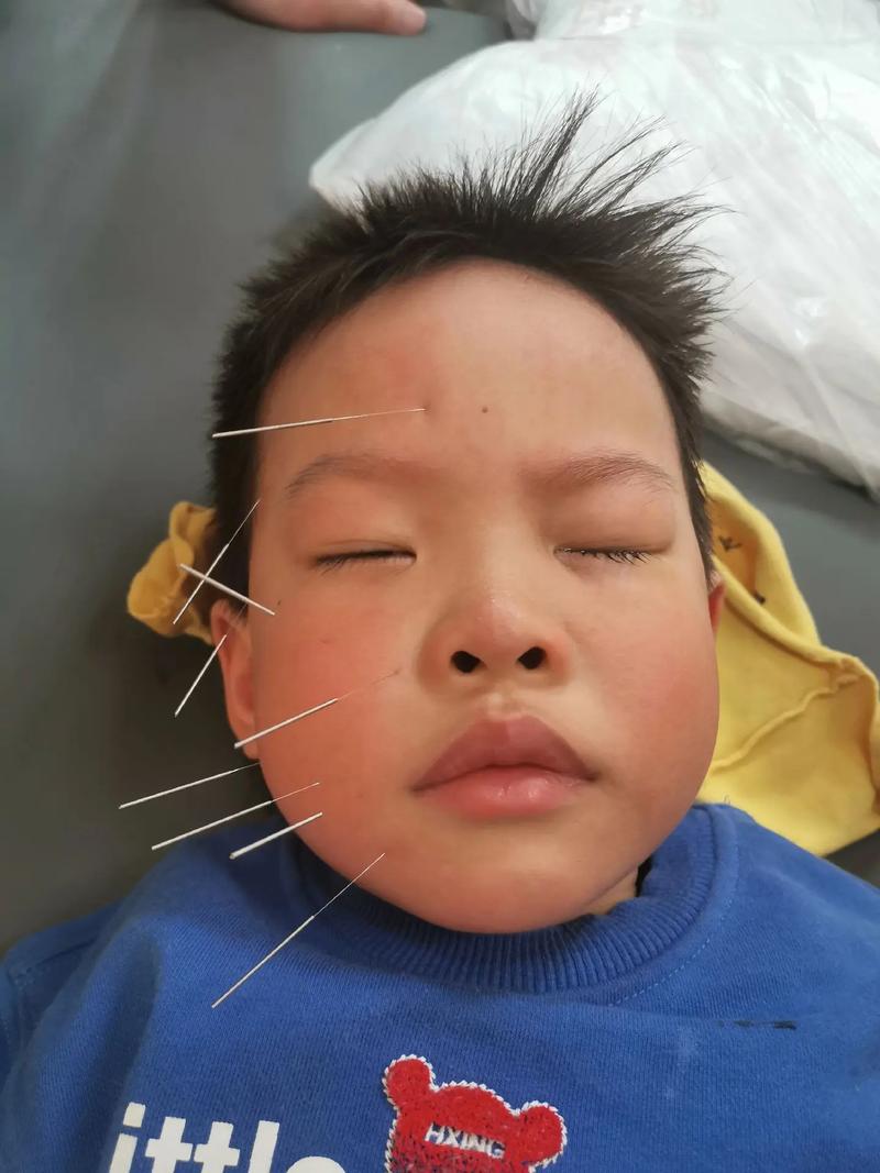 儿童面瘫可以针灸吗