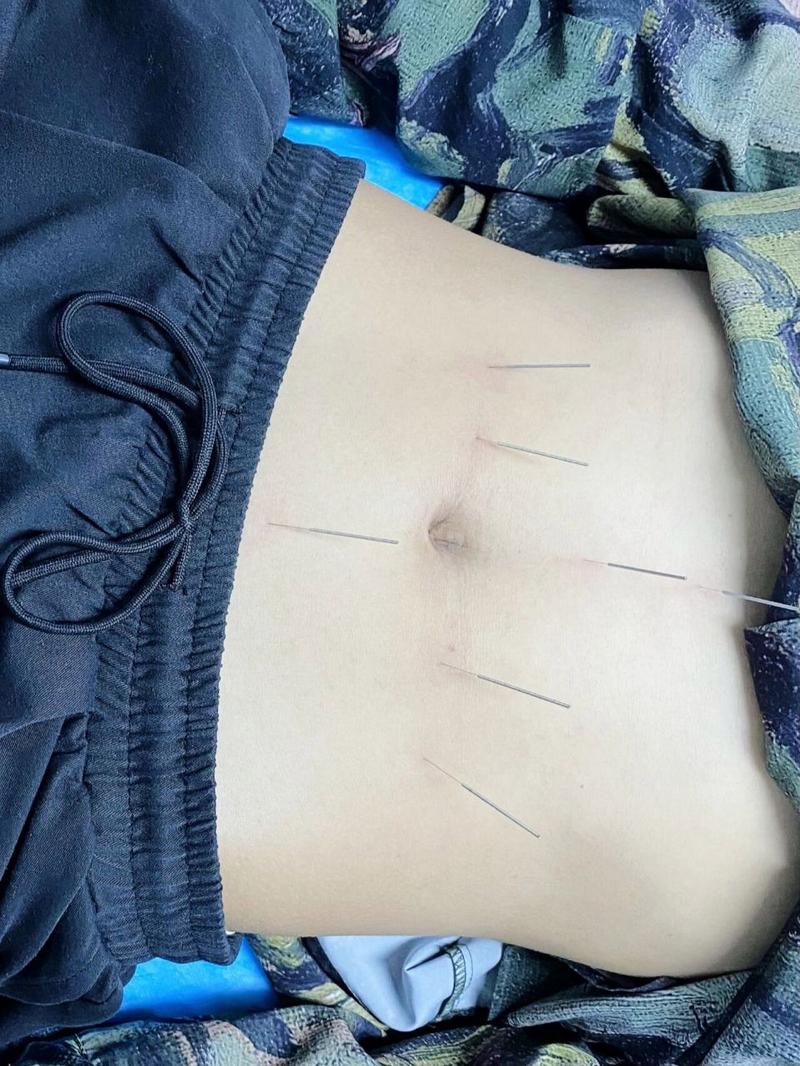脾胃不好针灸管用吗