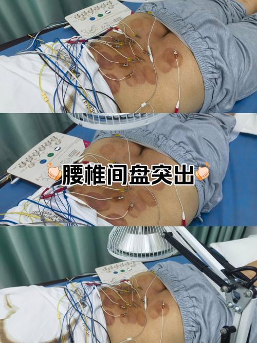 髋关节积液针灸治疗