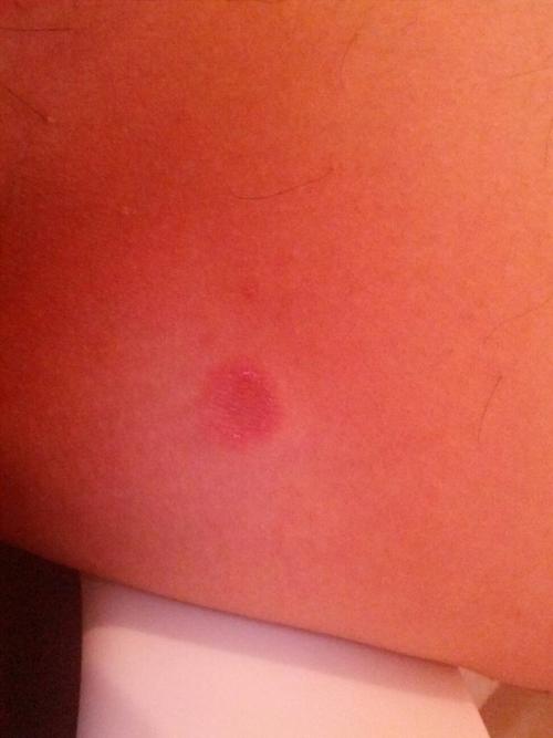 针灸后出现红色斑块