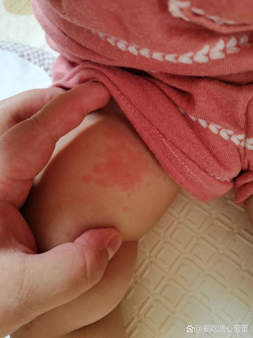 针灸后出现红色斑块