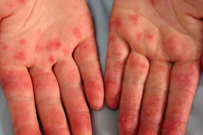 针灸后出现红色斑块