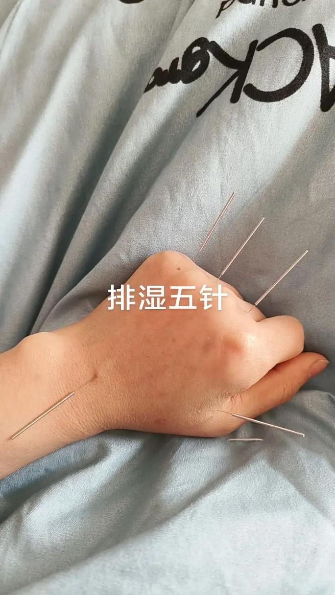 湿气重针灸什么穴位