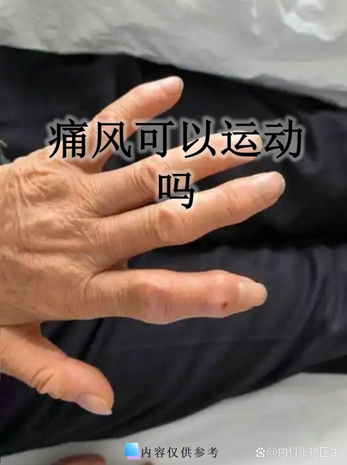 运动劳累引发痛风发