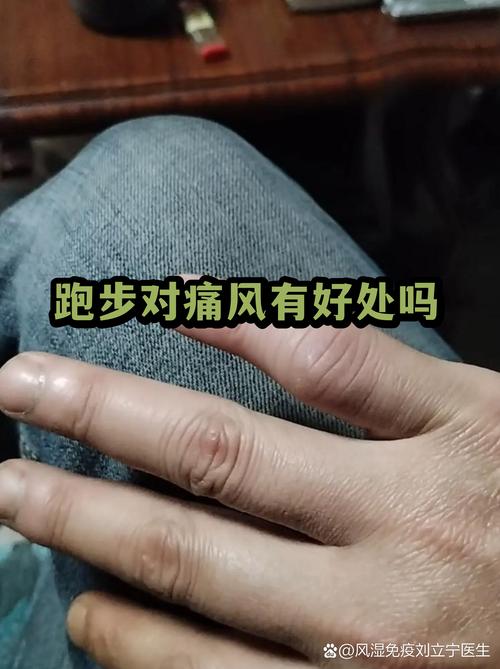 运动劳累引发痛风发
