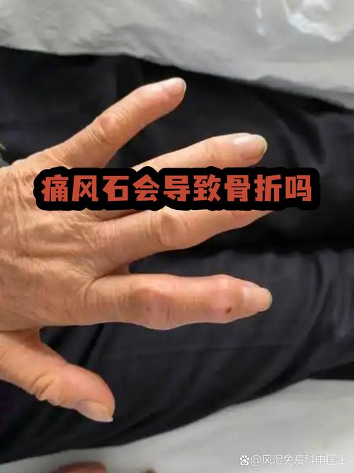 痛风会导致后背疼吗