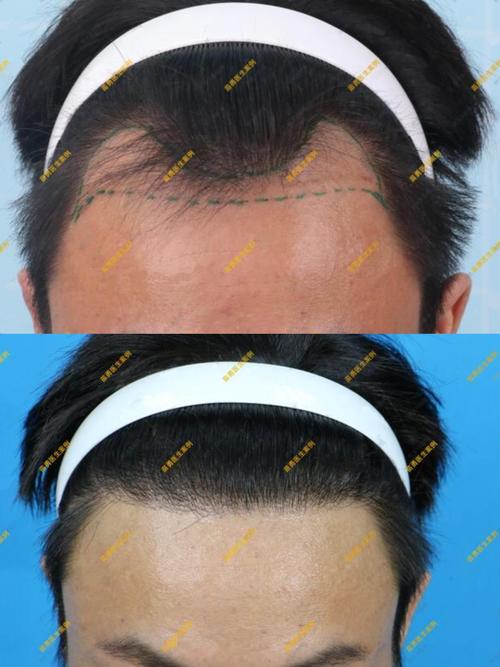 fue毛发移植安全吗