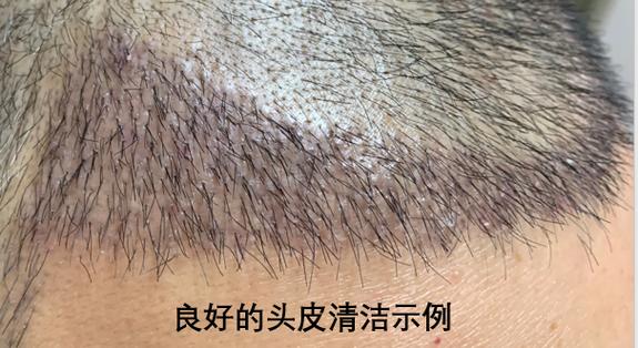 fue毛发移植安全吗