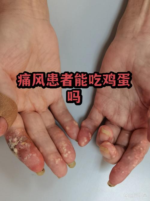 痛风发作能吃鸡蛋么