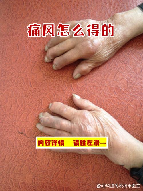 尿酸正常会有痛风吗