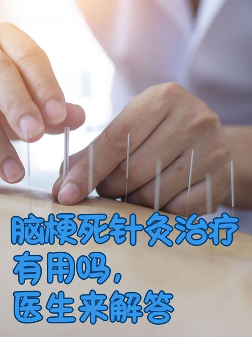 中医针灸治疗脑萎缩