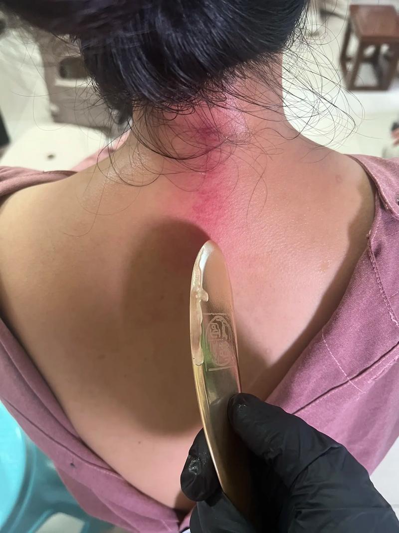 刮痧和针灸哪个减肥