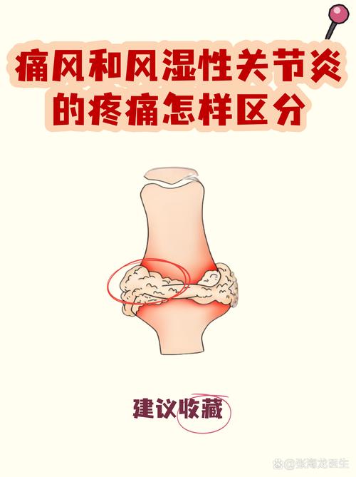 如何区分痛风和风湿
