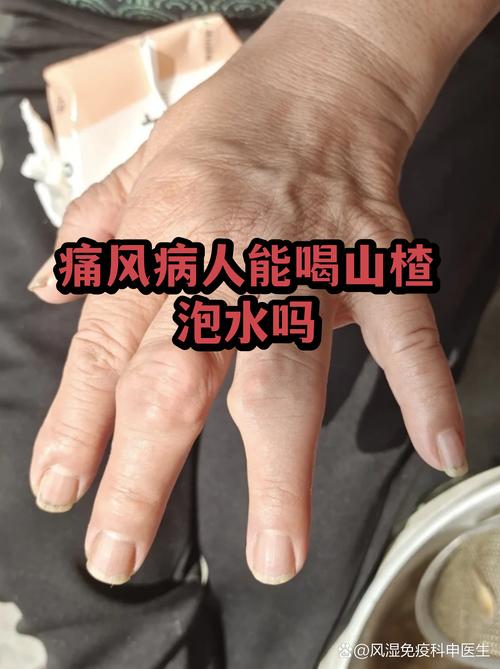 痛风能喝山楂饮料吗