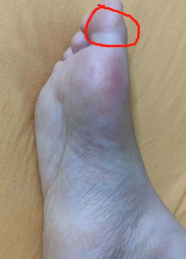 大拇指关节疼 痛风