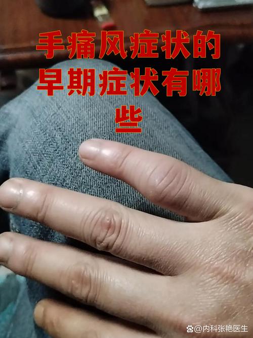 大拇指关节疼 痛风