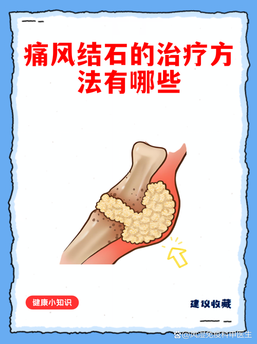 痛风肾结石如何治疗