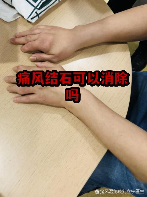 痛风肾结石如何治疗