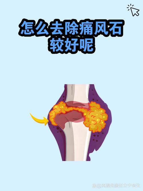 痛风肾结石如何治疗