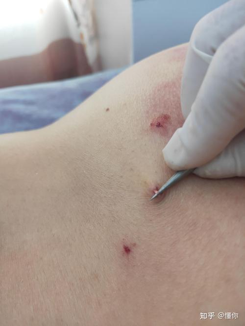 针灸挑刺疗法治痔疮