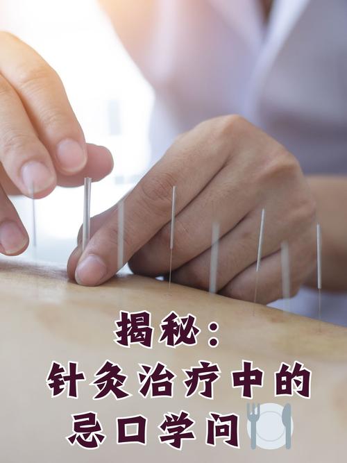 针灸挑刺疗法治痔疮