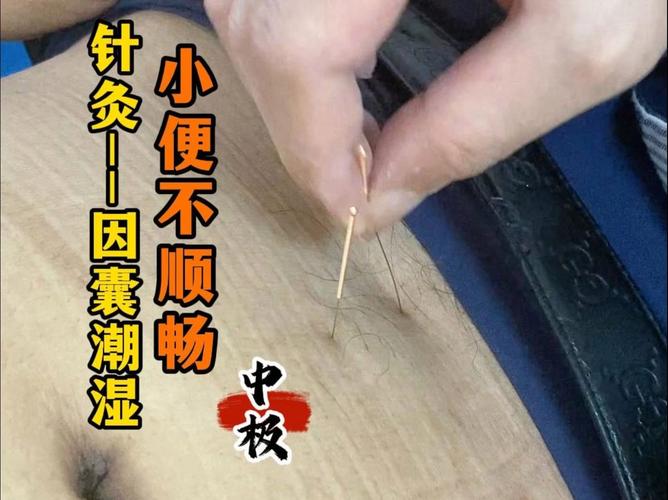 遗尿的针灸治疗视频