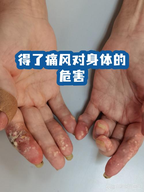 得了痛风就完蛋了吗