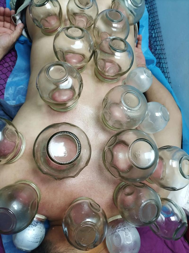 针灸丰胸会不会反弹