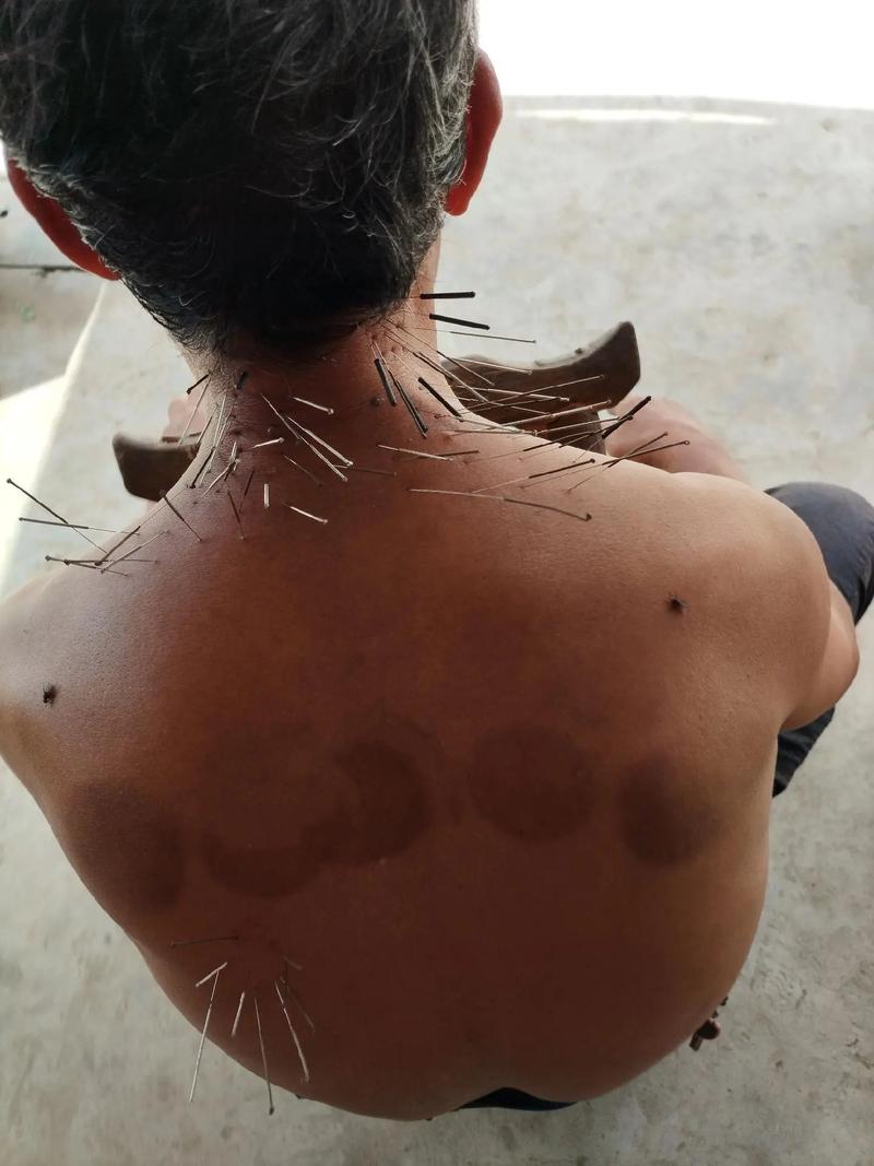 针灸后身体变得怕冷